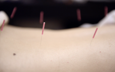 Acupuncture at Chi Yu