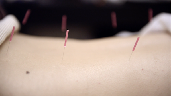 Acupuncture at Chi Yu