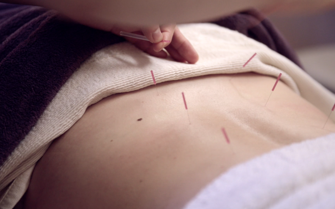 Acupuncture at chi yu wellness centre